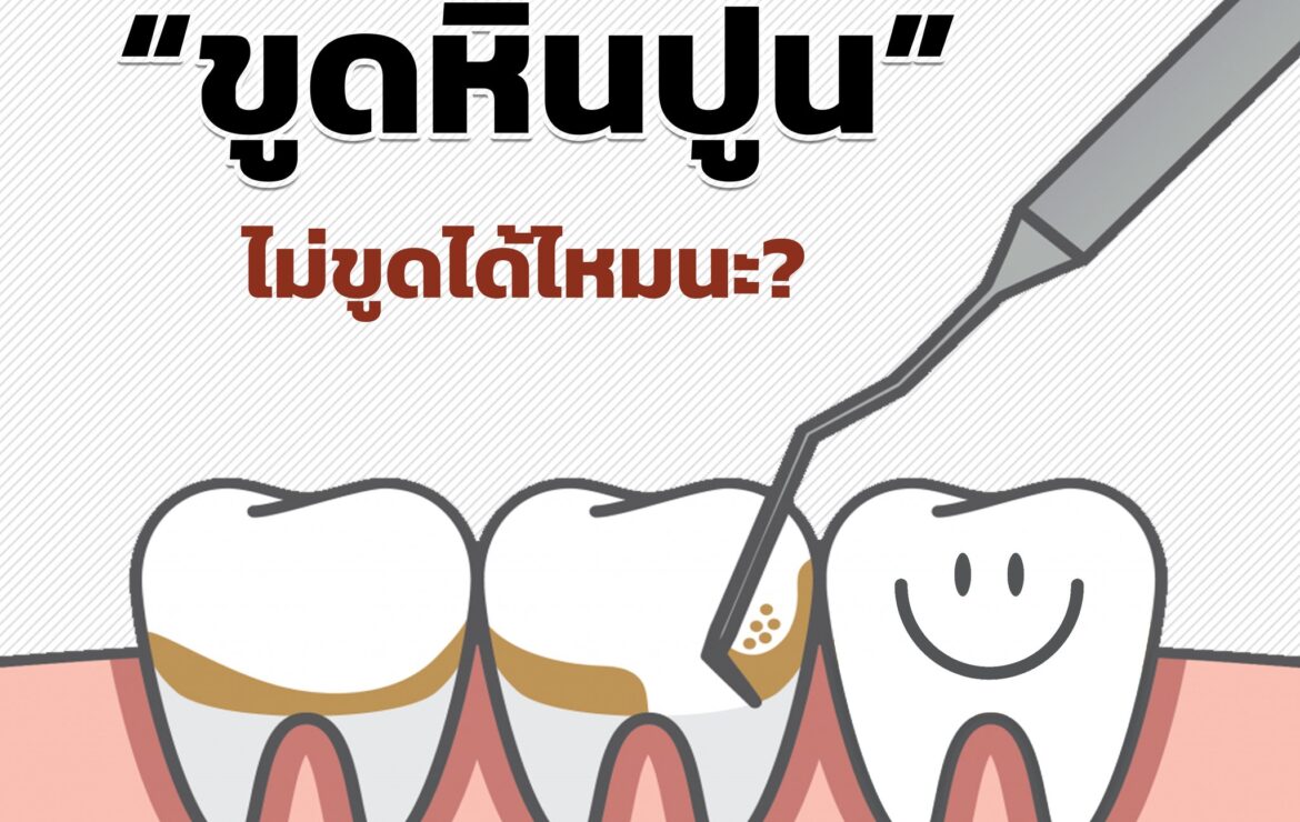 หินปูนคืออะไร? ทำไมต้องขูดหินปูน?