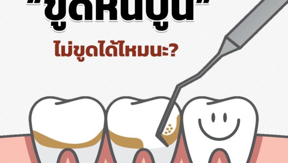 หินปูนคืออะไร? ทำไมต้องขูดหินปูน?