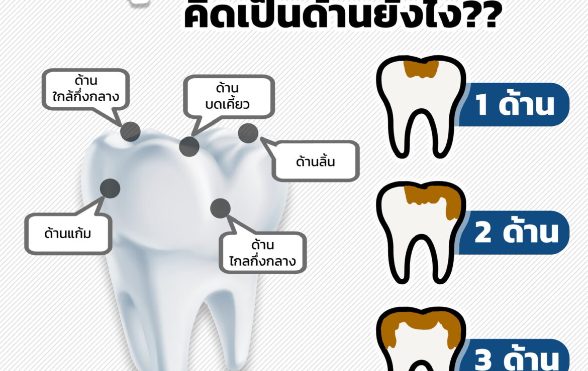 อุดฟันคิดเป็นด้าน คิดยังไง? ทำไมต้องเป็นด้าน?