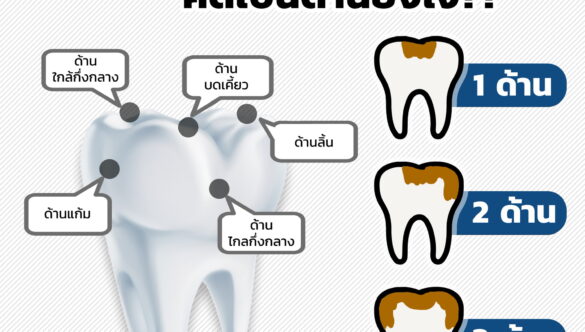 อุดฟันคิดเป็นด้าน คิดยังไง? ทำไมต้องเป็นด้าน?