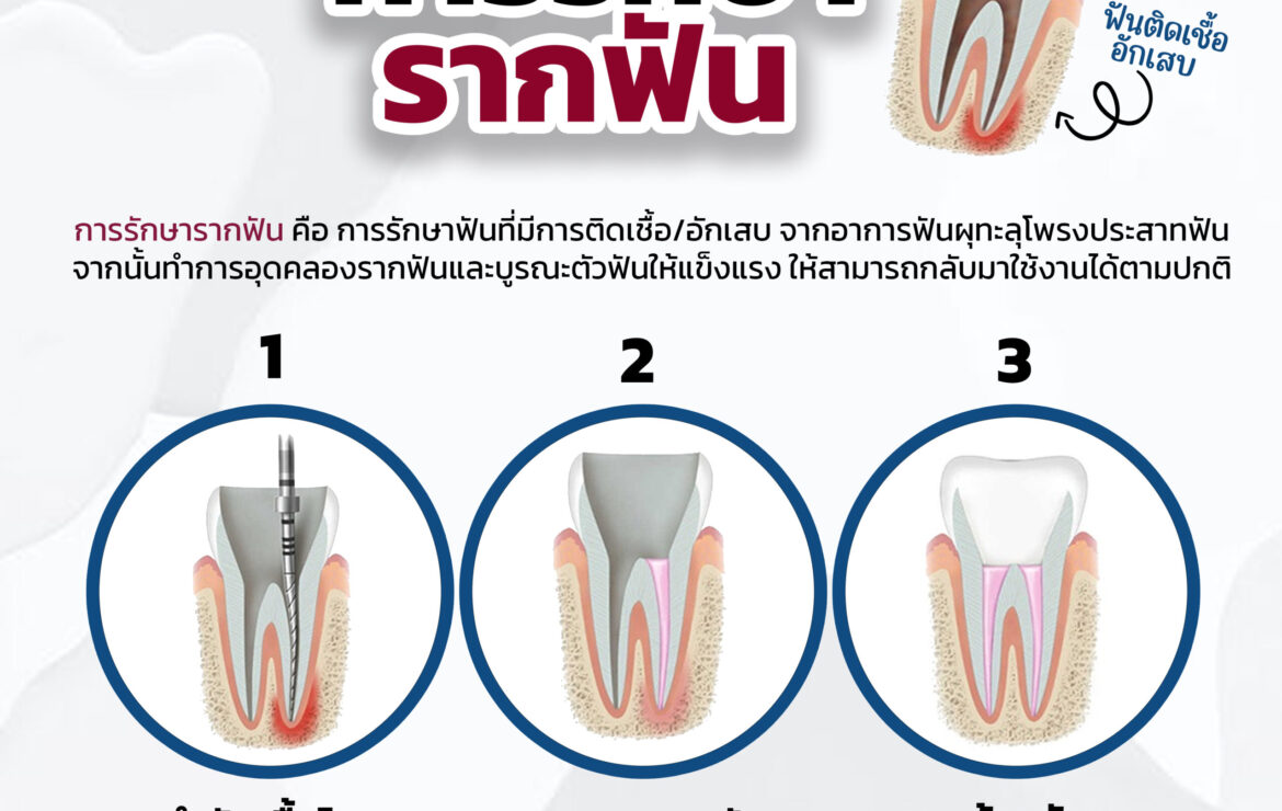 ตอบทุกข้อสงสัย “การรักษารากฟัน”