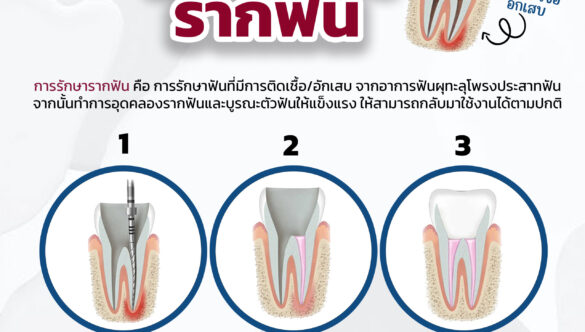 ตอบทุกข้อสงสัย “การรักษารากฟัน”