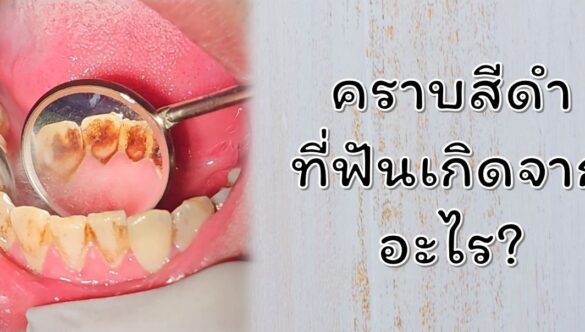 “คราบสีดำ” ที่ฟันเกิดจากอะไร?