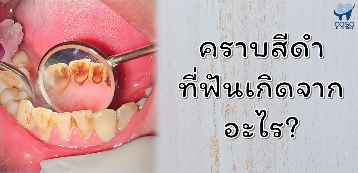 “คราบสีดำ” ที่ฟันเกิดจากอะไร?