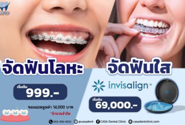 จัดฟัน