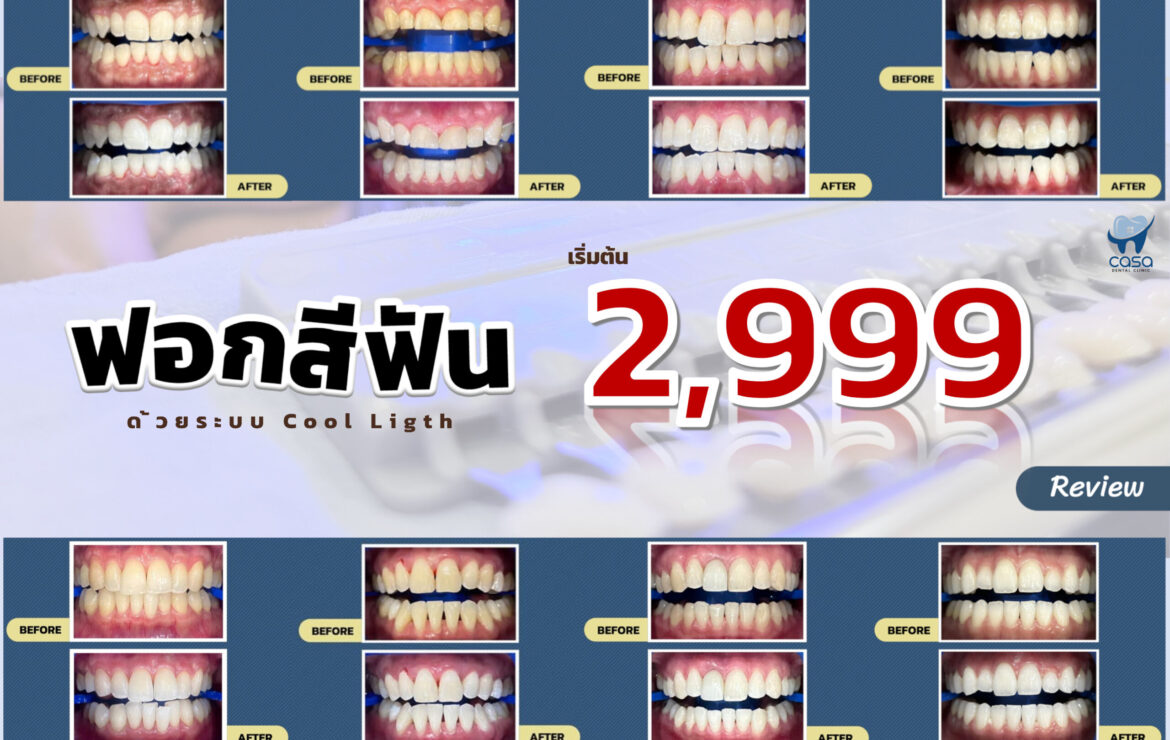 Is Teeth Whitening Painful?