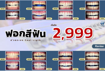 ฟอกสีฟัน