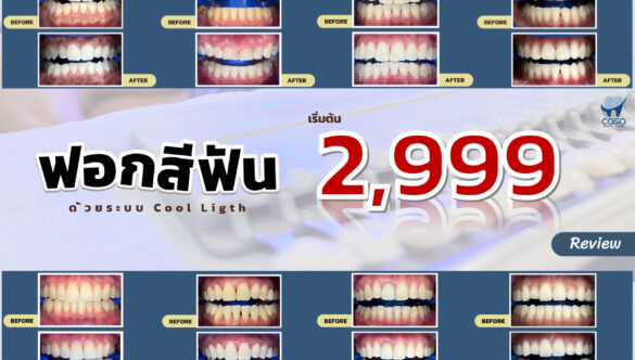 What Causes Black Stains on Teeth?