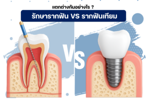 รากฟันเทียม VS รักษาฟันราก ต่างกันอย่างไร ?