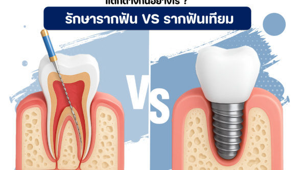 รากฟันเทียม VS รักษาฟันราก ต่างกันอย่างไร ?