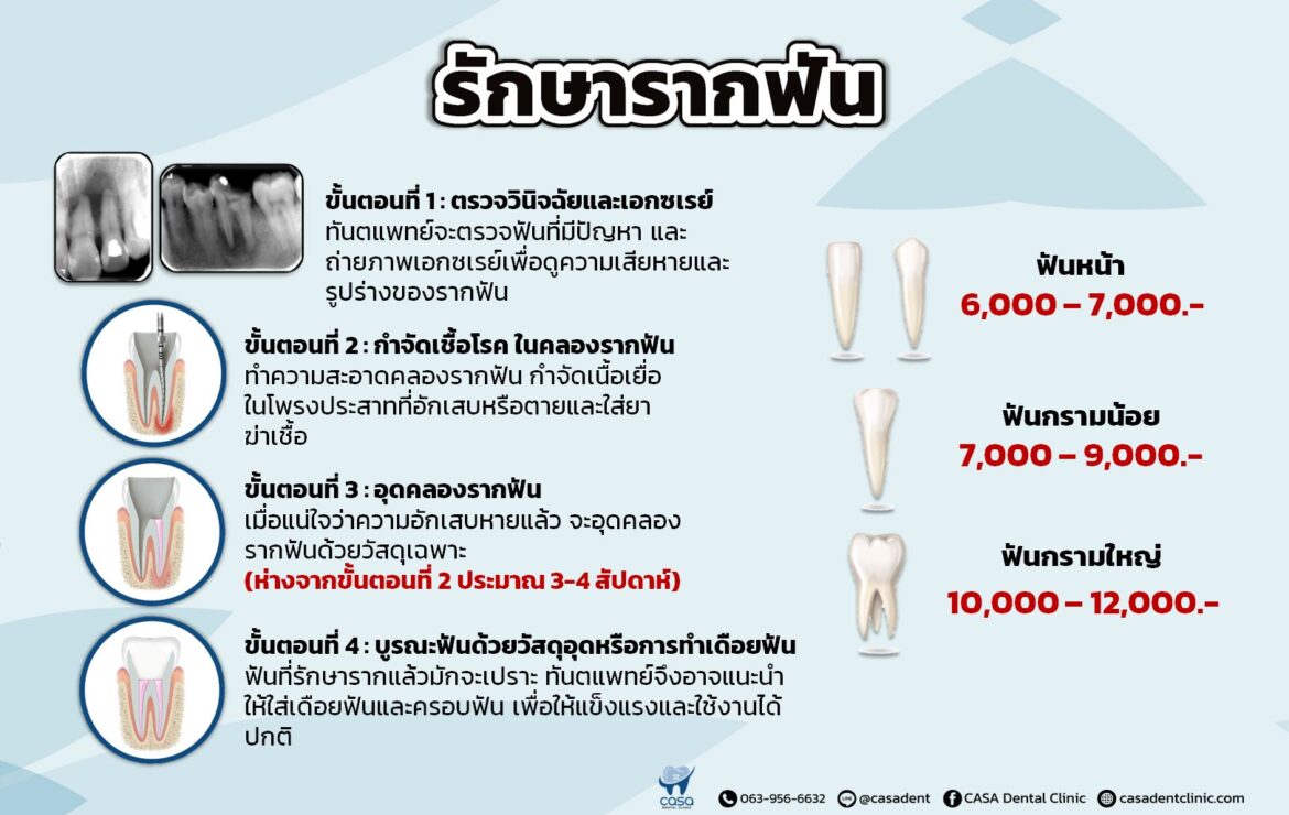 Root Canal Treatment: Procedure