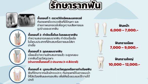 Root Canal Treatment: Procedure