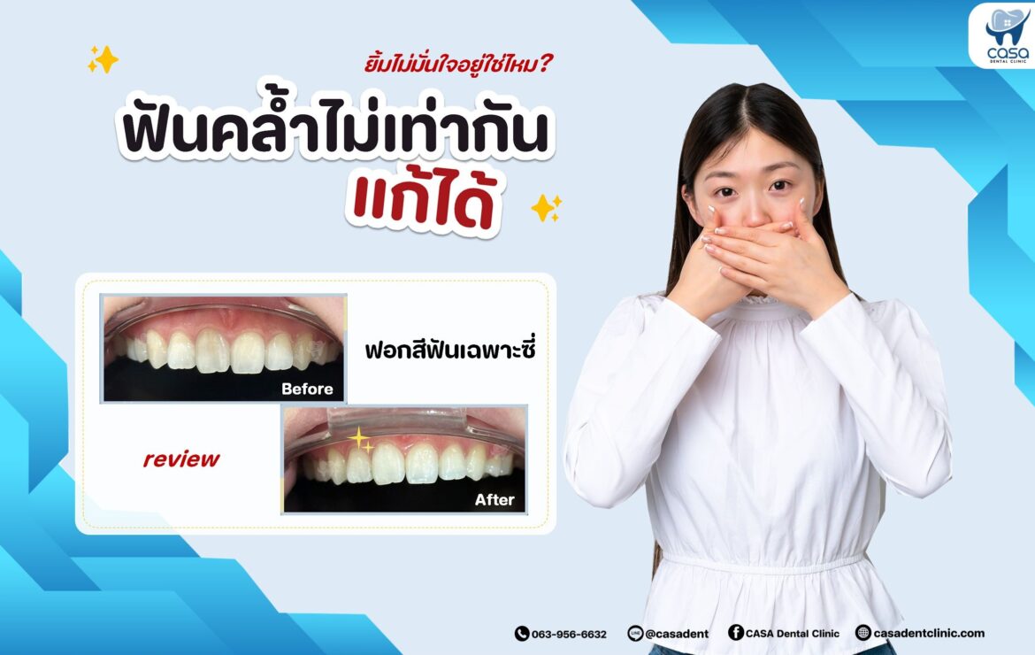 ทำไม “ฟันตาย” ถึงทำให้สีฟันคล้ำ ?