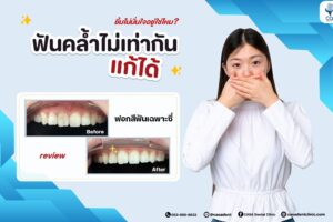 ทำไม “ฟันตาย” ถึงทำให้สีฟันคล้ำ ?