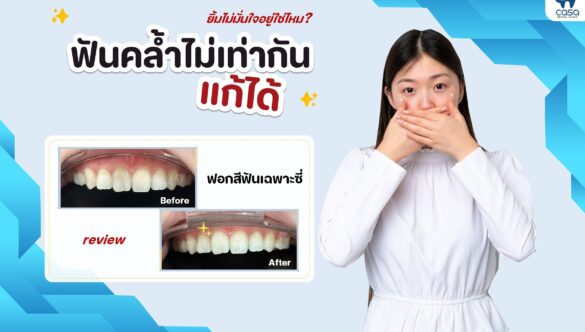 ทำไม “ฟันตาย” ถึงทำให้สีฟันคล้ำ ?