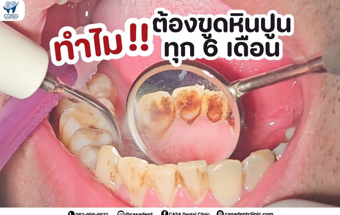 ทำไมต้องขูดหินปูนทุก 6 เดือน ?