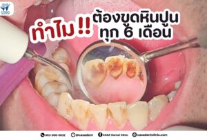 ทำไมต้องขูดหินปูนทุก 6 เดือน ?
