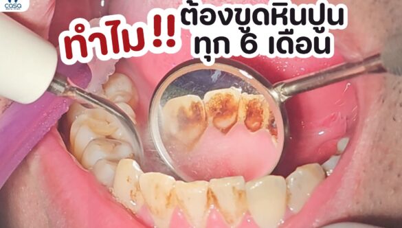 ทำไมต้องขูดหินปูนทุก 6 เดือน ?