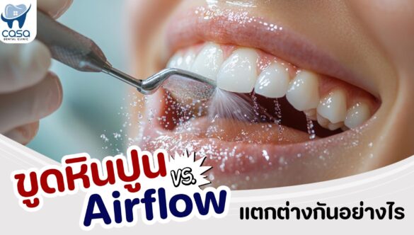 ขูดหินปูน vs Airflow แตกต่างกันอย่างไร ?