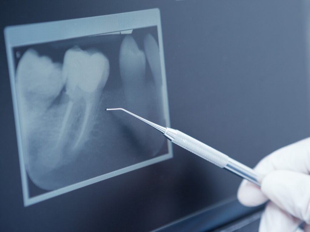 Periapical dental x-ray