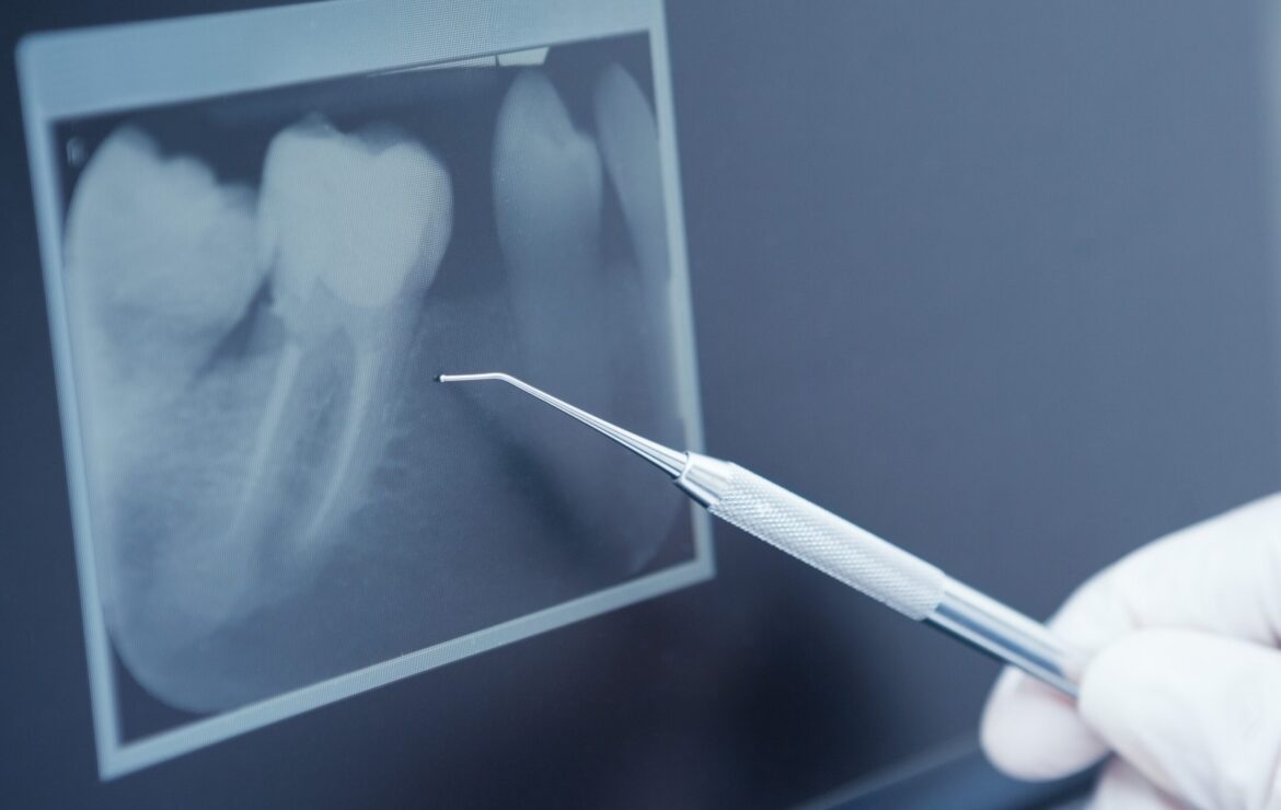 Dental Implants vs Root Canal