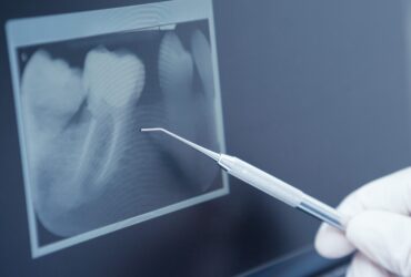 Wisdom Tooth Extraction & Impacted Tooth Surgery