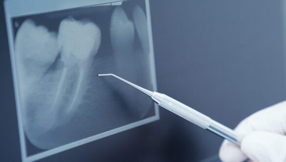 Dental Implants: Replacing Missing Teeth from Root to Crown