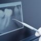 Dental Implants: Replacing Missing Teeth from Root to Crown