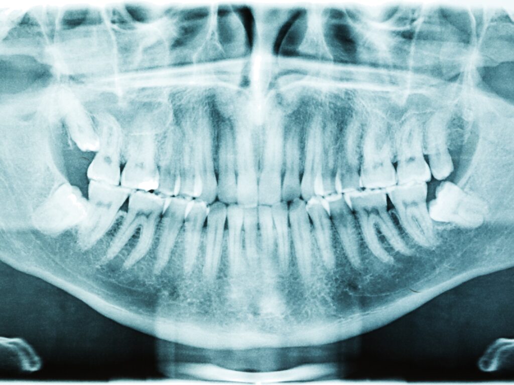 Panoramic dental x-ray