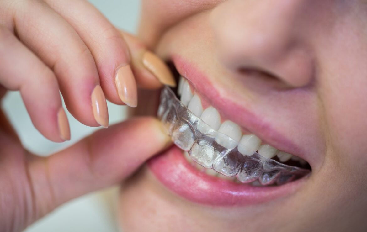 5 Steps to Getting Braces