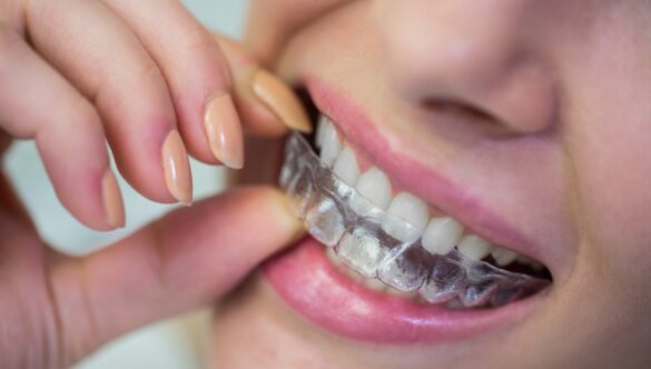 5 Steps to Getting Braces