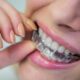 5 Steps to Getting Braces