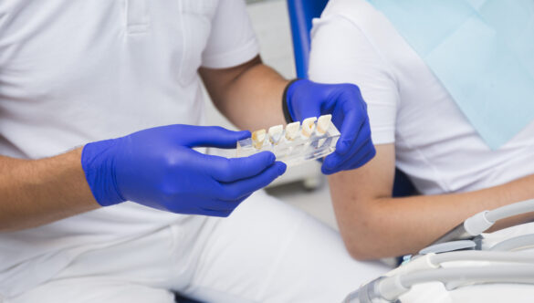 Dental Veneers